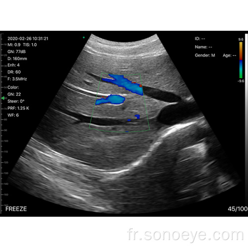 Scanner à ultrasons sans fil de sonde convexe